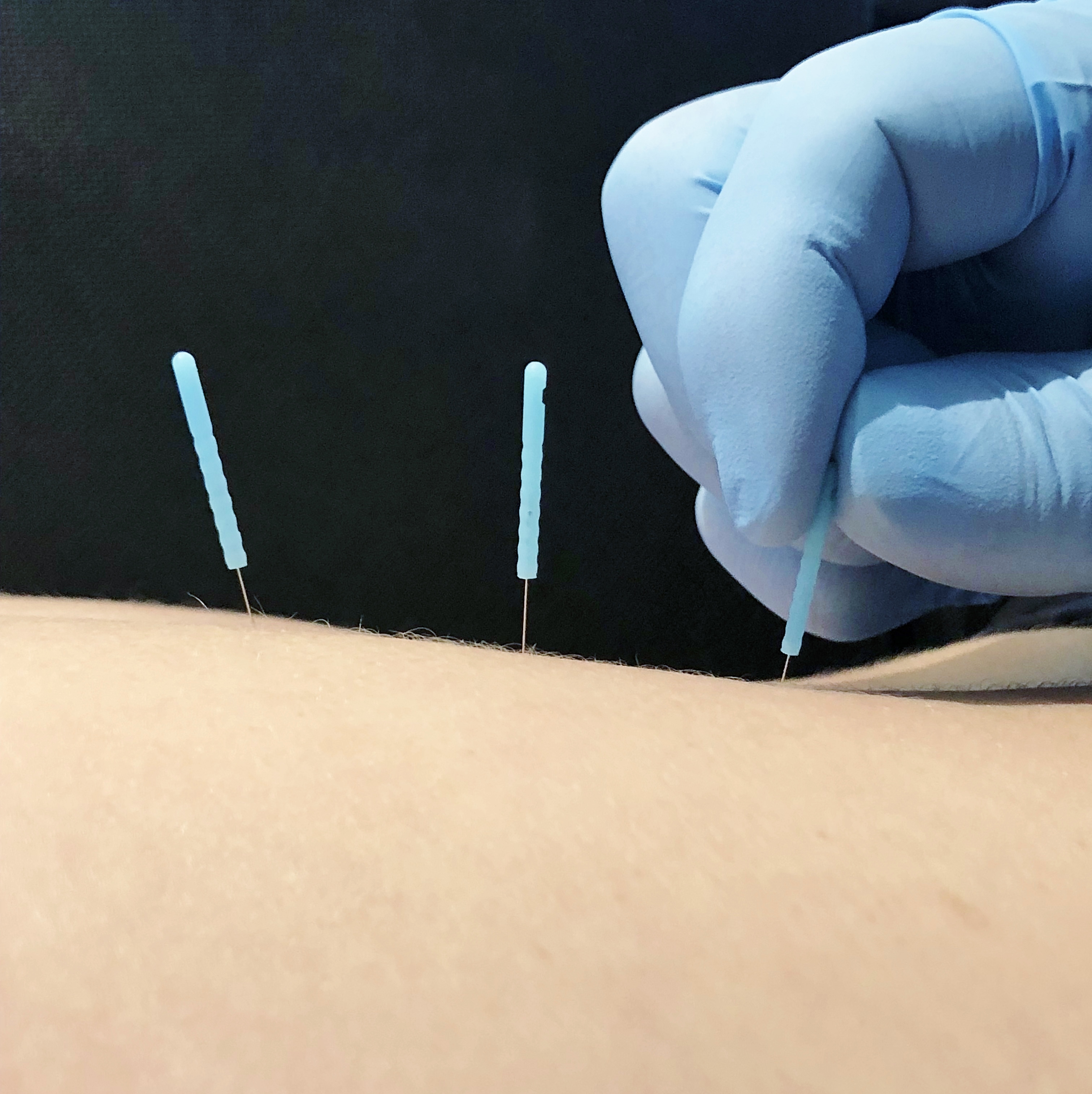 Physical Therapist In Mooresville Dry Needling In Mooresville K2 Sports Therapy And Performance